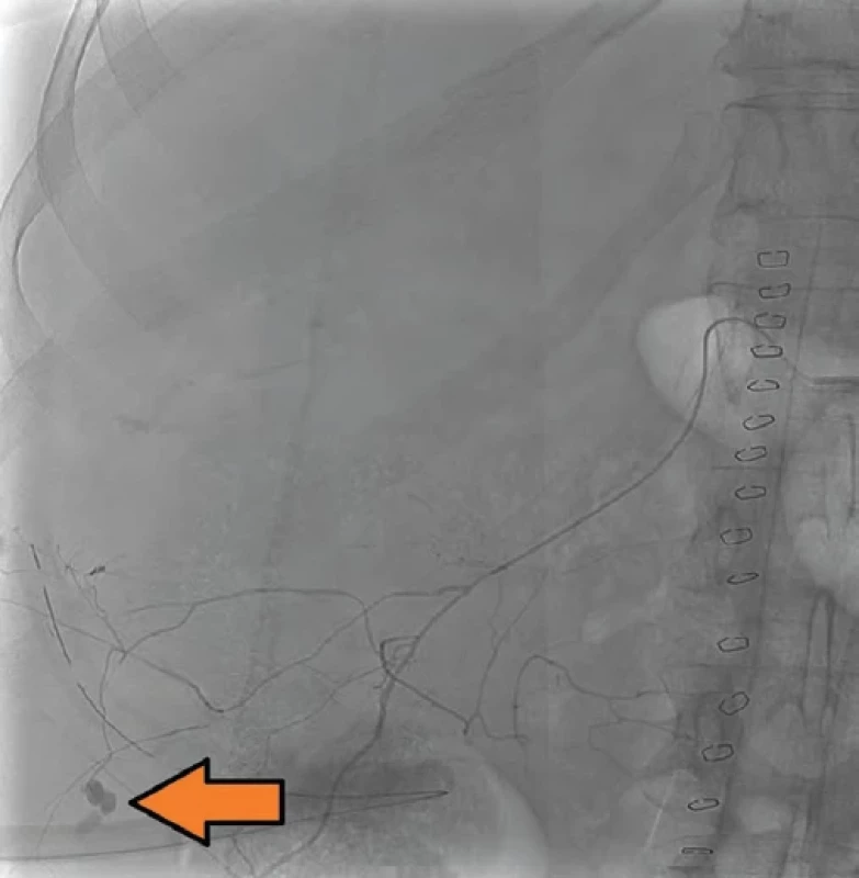 Kontrolní angiografie po úspěšné embolizaci akrylátovým lepidlem. Fig. 5. Control angiography after successful embolization with acrylate glue.