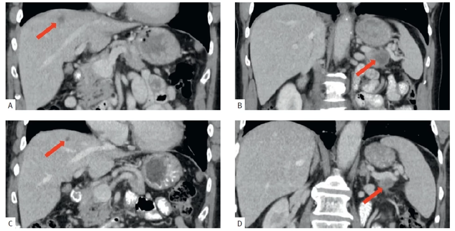CT nálezy v době diagnózy a po chemoterapii před resekčním výkonem.<br>CT findings at the time of diagnosis and after chemotherapy prior to resection.