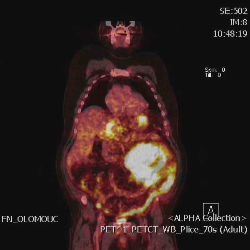 PET/CT objemného lymfomu dutiny břišní
Fig. 1: PET/CT scan of extensive lymphoma in the abdominal cavity