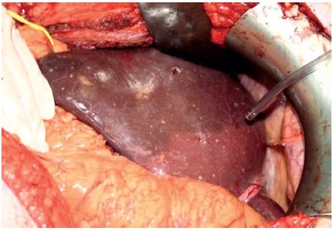 Peroperační foto – jaterní parenchym s mnohočetnými drobnými ložisky, jedno excidováno na kryohistologické vyšetření
Fig. 3: Intraoperative image – liver parenchyma with multiple small nodules; one excised for the frozen section procedure