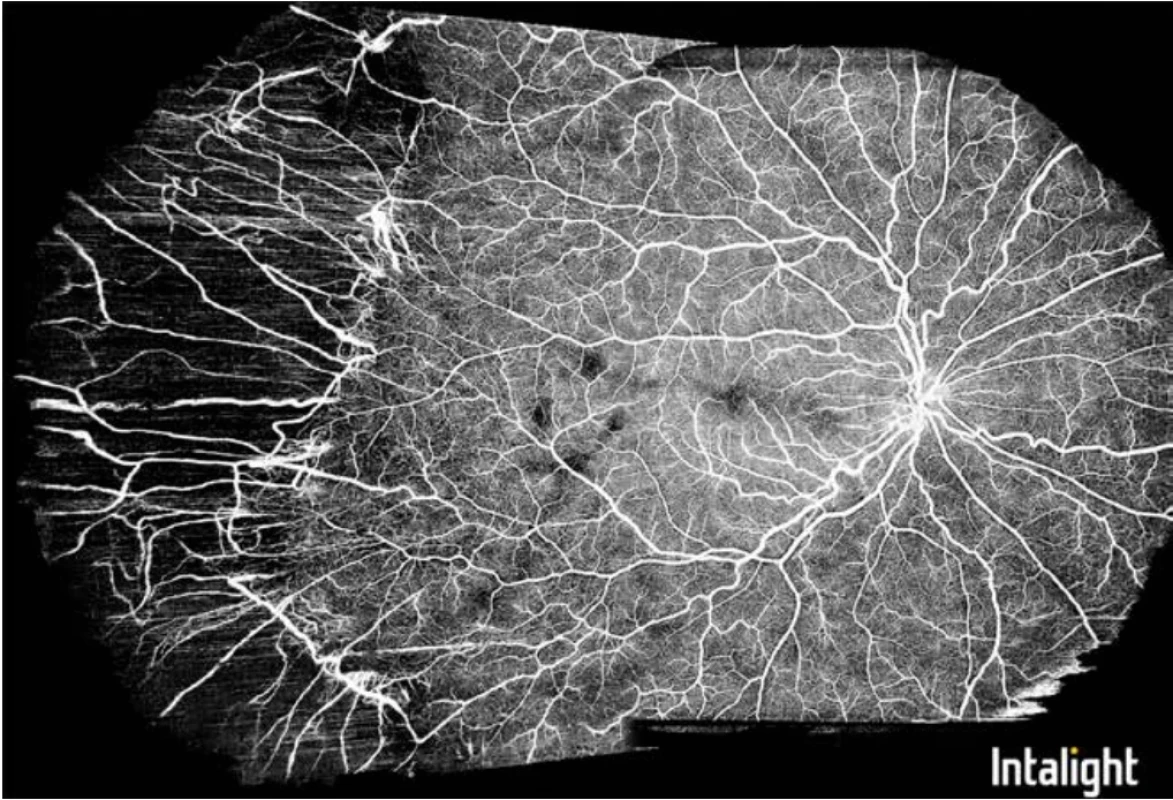 Montáž z dvoch UWF-OCTA snímkov odhaľuje staré zjazvenie periférnej sietnice s  presvitajúcimi choroidálnymi cievami, ošetrenej kvôli retinopatii prematúrnych, centrálne lokálne zóny s  nepravidelnosťou kapilár a  malým priemerom foveálnej avaskulárnej zóny