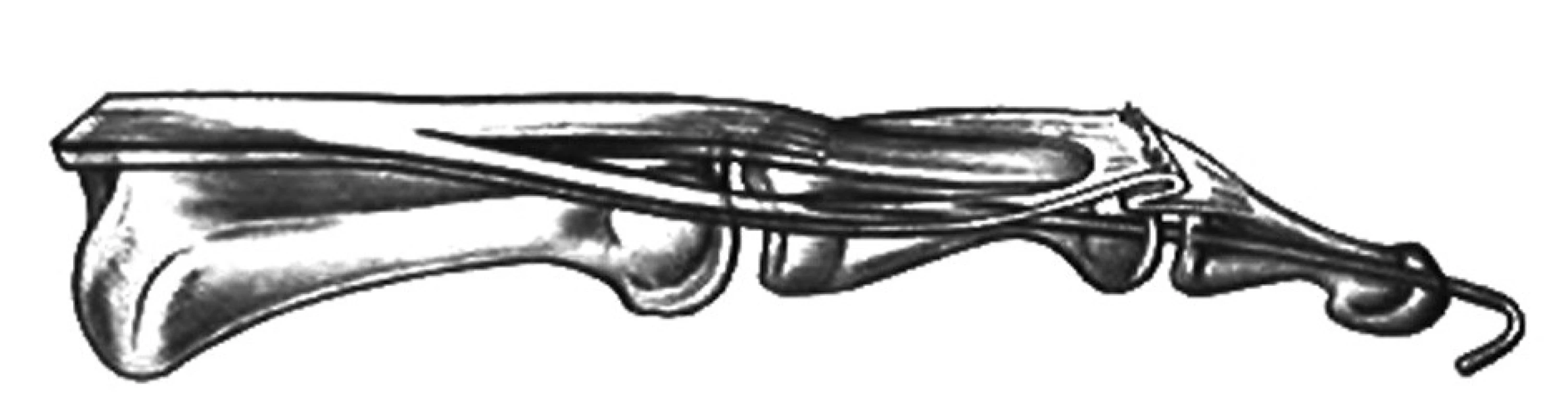 Metóda zriasenia extenzora v zóne II na korekciu mallet deformity Materiál z Oddělení plastické chirurgie, Krajská nemocnice T. Bati, a.s., Zlín, ČR, s povolením primára.
Fig. 6: Correction of the mallet deformity with shortening of the extensor in the zone II Material from the Department of Plastic Surgery, City Hospital of T. Baťa, Ltd., Zlín, CZ, with permission of the head of the department.