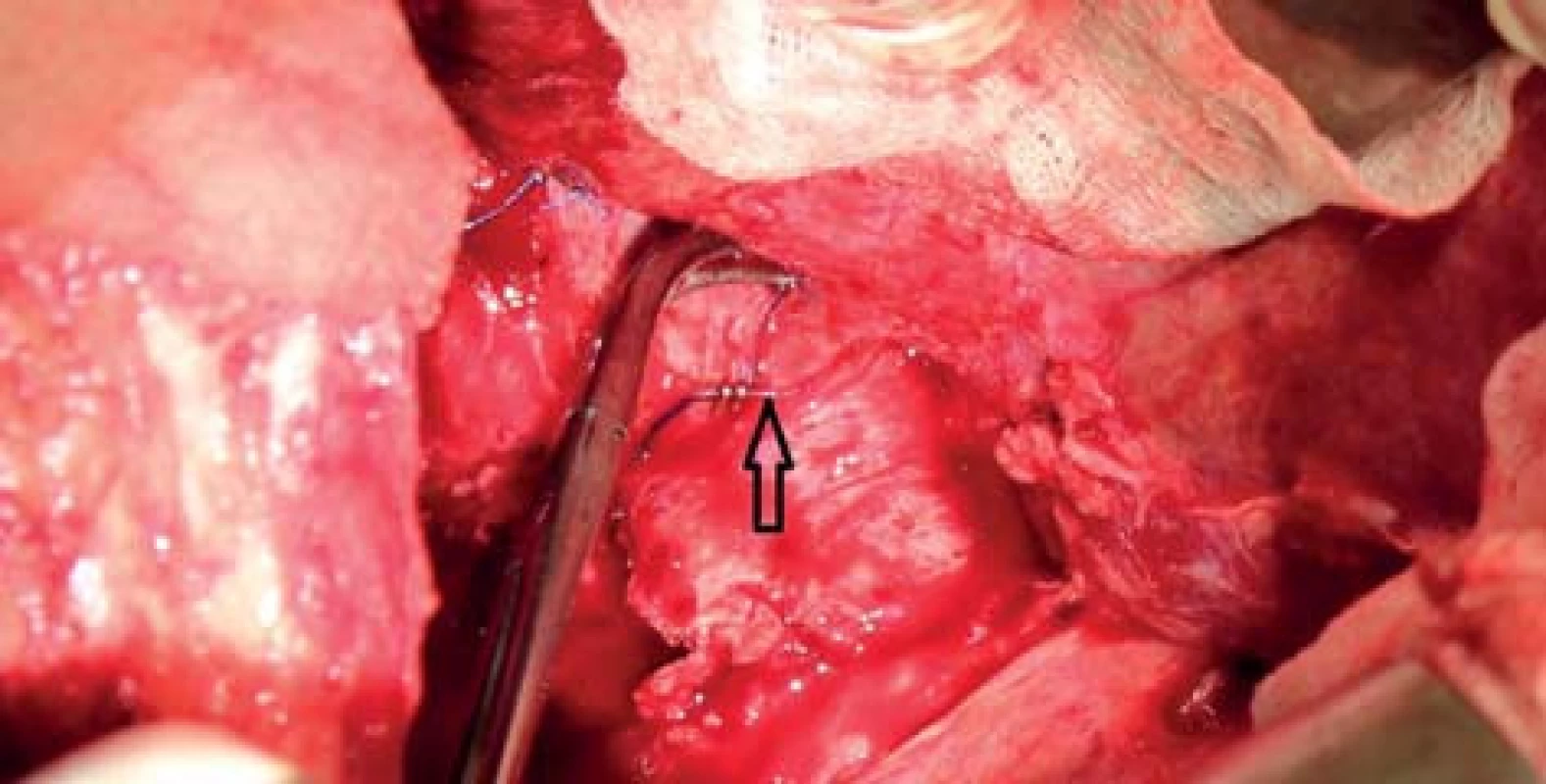 Označení větví VCI modrým vláknem (šipka)
Fig. 1: Marking IVC branches with blue thread (black arrow)