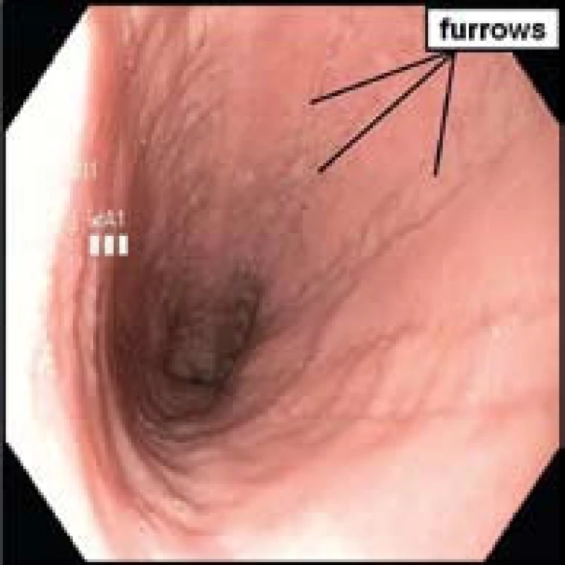 Endoskopický obraz typických podélných rýh (furrows) u pacienta s dg. EoE.
Fig. 4. Endoscopic image of typical longitudinal furrows in a patient with EoE.