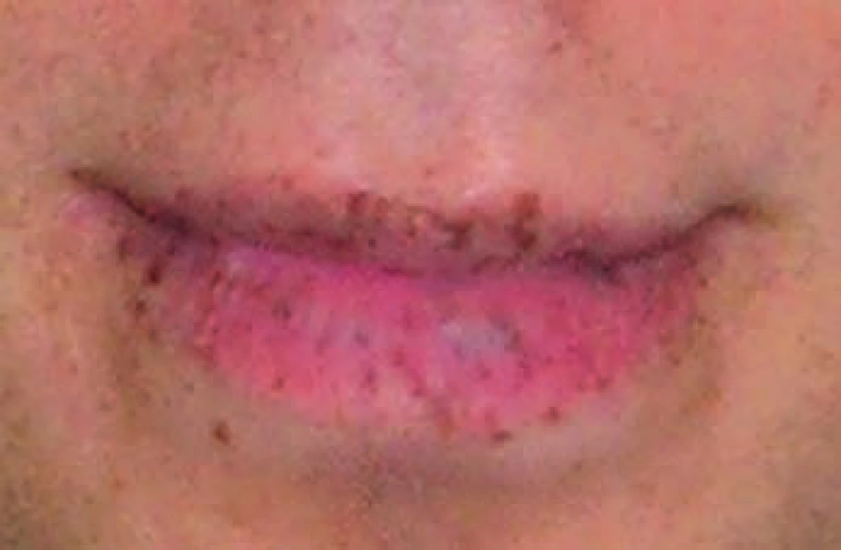 Mukokutánne pigmentácie pacienta s P-J syndrómom geneticky vyšetreného na odd. klinickej genetiky NOÚ, Klenova, Bratislava.
Fig. 1. Mucocutaneous pigmentation of a patient with P-J syndrome, who was genetically tested at the Department of Clinical Genetics at the National Oncological Institute in Klenova Street in Bratislava.