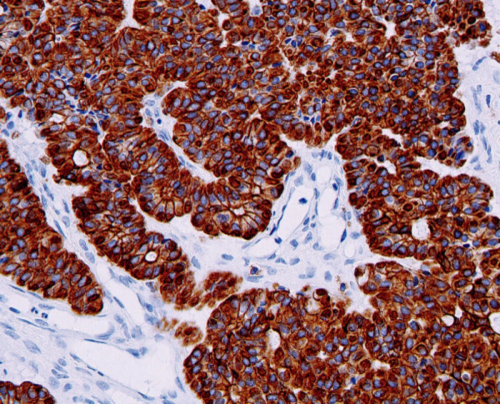 Pozitivita nádorových buněk s protilátkou proti cytokeratinu, 200krát