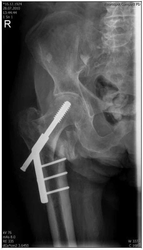 RTG dokumentace 86letého pacienta s časně komplikovanou DHS „Z“ efektem 8 dní po osteosyntéze 
a - chybná indikace a chybné technické provedení s nedostatečnou valgizací fragmentů při repozici, medializace diafýzy, prominence laterální části šroubu DHS do měkkých tkání stehna