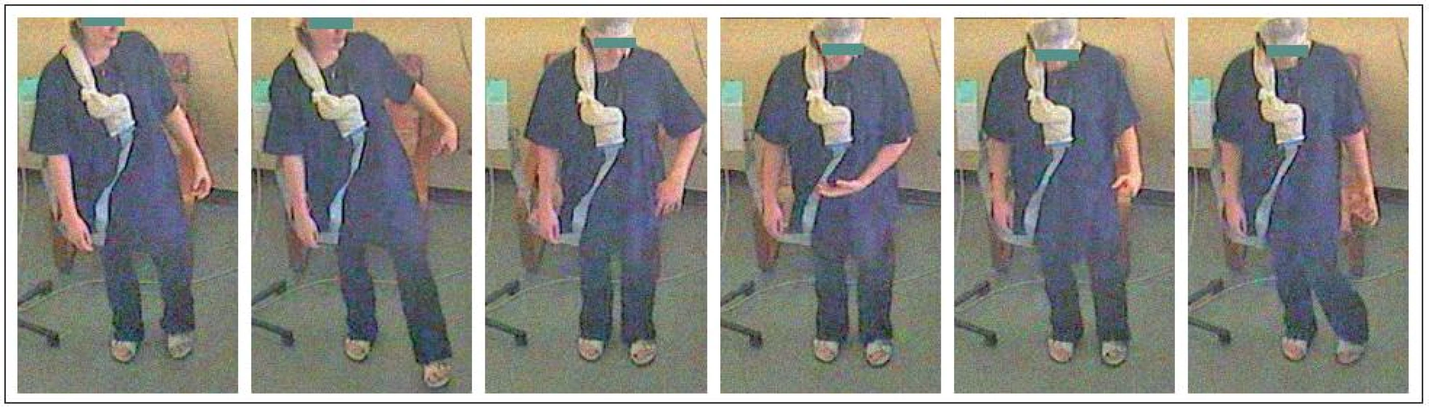 <b>Paroxysmální kinezigenní dyskineze vyvolaná neplánovaným náhlým pohybem.</b>
Křeč začínající na akru levé dolní končetiny následně doprovázená dystonickým zkroucením ipsilaterální horní končetiny. Série obrázků následujících za sebou po 2 sekundách zachycuje záchvat trvající celkem cca 10 sekund.