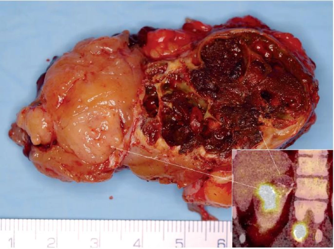 Muž 29 let, tubulocystický renální karcinom horního pólu pravé ledviny T1bN0M1 s metastázami do skeletu. Na obrázku je vidět preparát tumoru po translumbální resekci jednak se solidní částí (na FDG PET v pravém dolním rohu tato část vychytává FDG), tak s cystickou (na preparátu vpravo). Na FDG PET CT patrná i metastáza do obratle. 
Fig. 1. Twenty nine year old man, tubulocystic renal cell carcinoma of the upper pole of the right kidney T1bN0M1 with bone metastases. CT showing a tumour specimen during surgery with the translumbar approach: with solid part (on FDG PET CT in the right lower corner there is FDG uptake) and cystic part (on specimen on the right side). On FDG PET CT, metastasis to spinal column is visible as well.