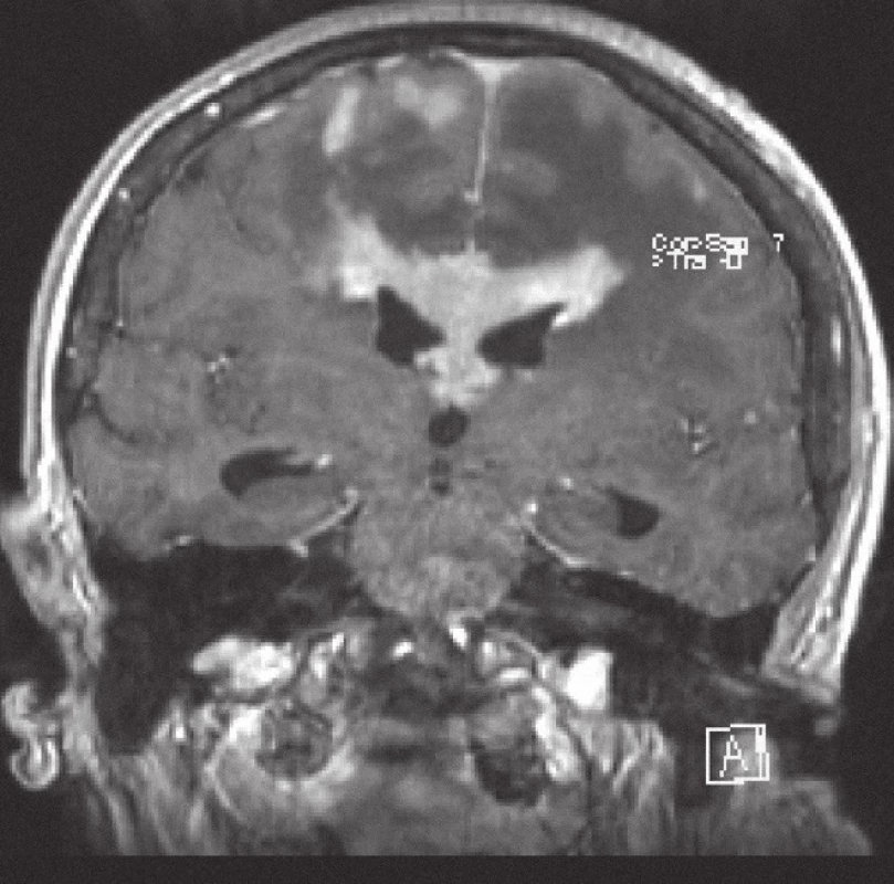 Magnetická rezonance, FLASH T1 s kontrastní látkou i.v. Pacientka K. A. 1941, koronární řez, kontrastně se sytící infiltrát lymfomu v corpus callosum a periventrikulárně, hyposignální vazogenní edém v okolí.