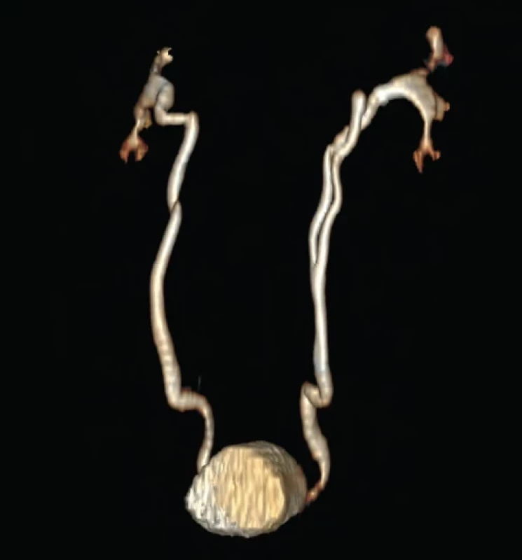 3D rekonstrukce lépe zobrazuje anatomické poměry slepě zakončeného ureteru. Fig. 2. 3D reconstruction better shows anatomical proportions of the blind-ending ureter.