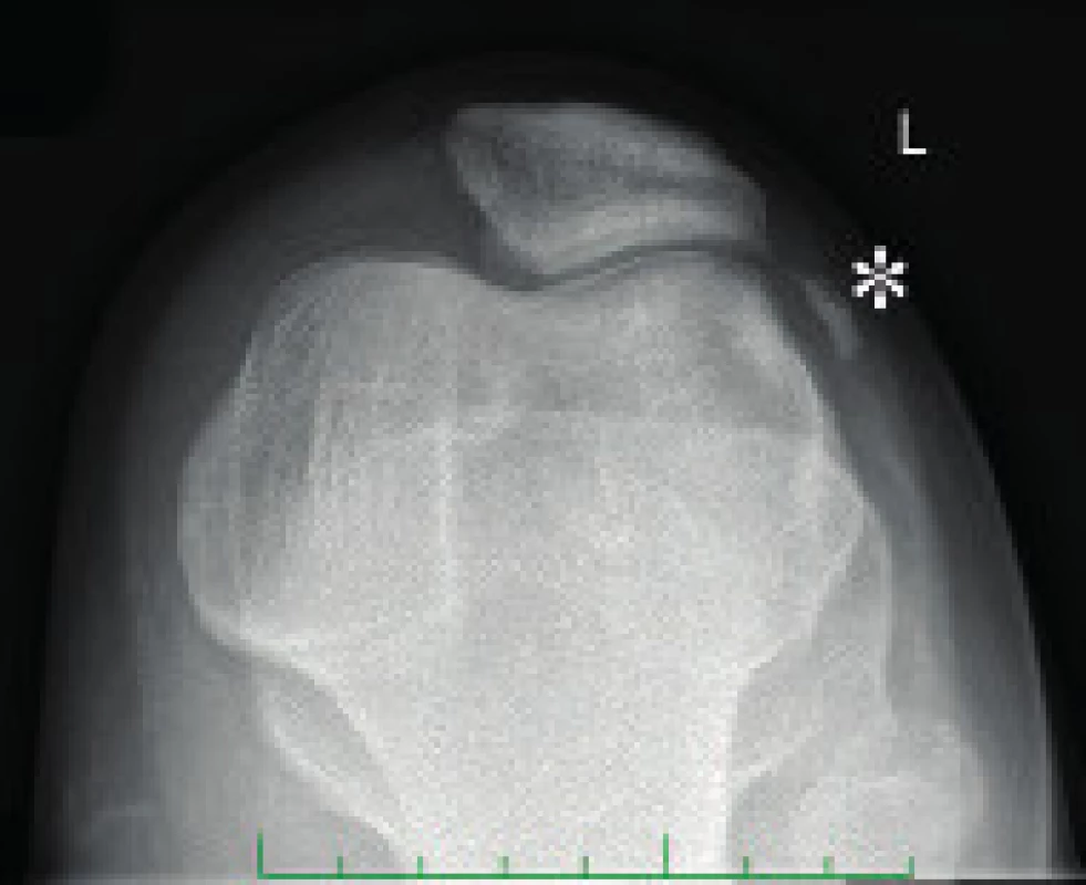 Axiální snímek pately s patrným osteochondrálním fragmentem z mediální facety pately po proběhlé luxaci pately – značka označuje pozici odlomeného fragmentu.
Fig. 7. Axial X-ray of the patella with medial facete osteochondral fragment after patellar dislocation – free fragment marked.