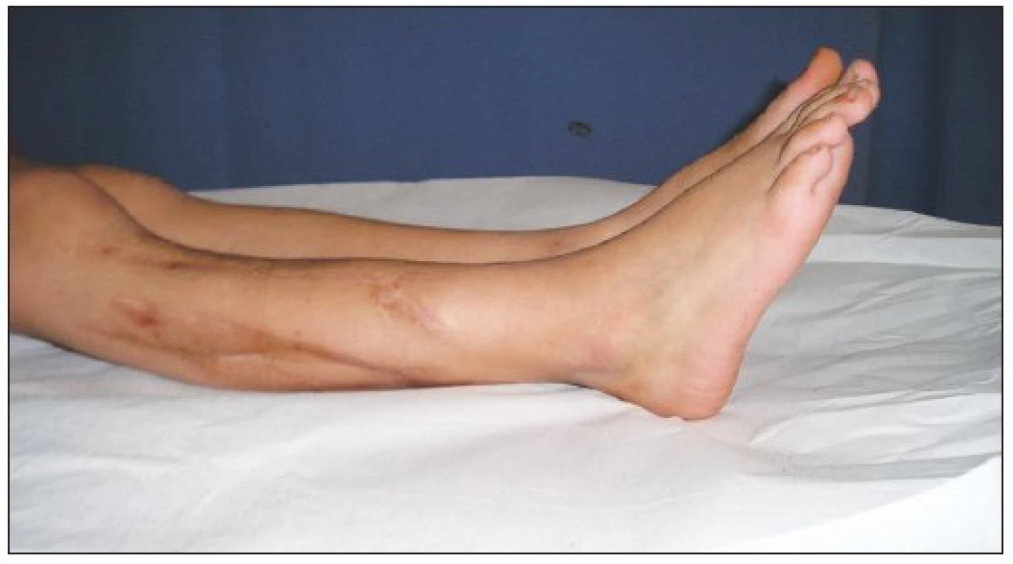 Clinical outcome – two years follow-up