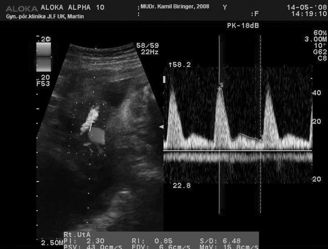 Prietok krvi v ľavej uterinnej artérii