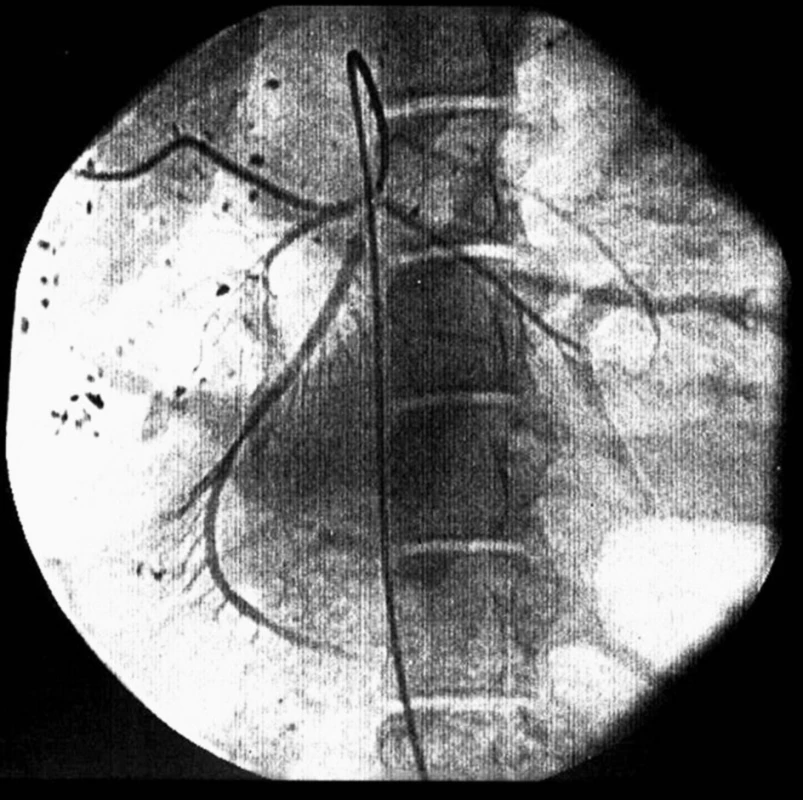 Angiografie periferní větve horní mezenterické tepny
Fig. 1. Angiography of peripheral branch of superior mesenteric artery