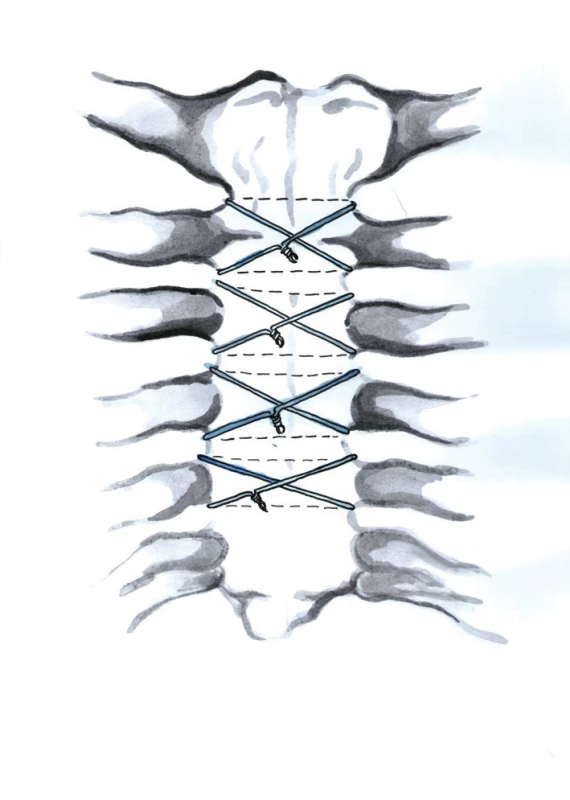 Peristernální drátěné osmičky (Kresba archiv autora)
Fig. 5: Figure-eight peristernal wire closure