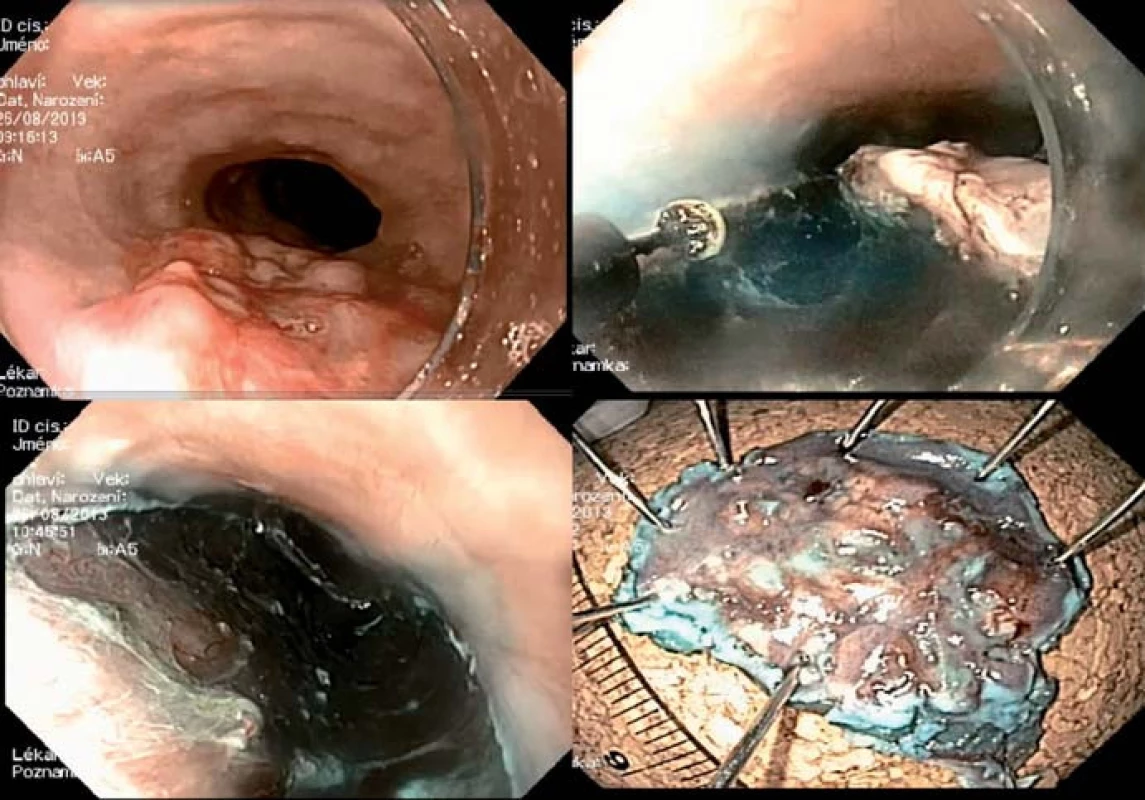 ESD spinocelulárního nádoru jícnu – en blok resekce.
Fig. 3. ESD of a squamous cell carcinoma of the oesophagus – en bloc resection.