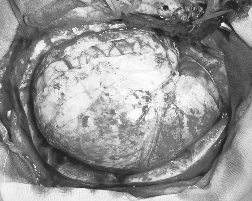 Durotomie s následným defektem tvrdé pleny způsobeným prolapsem edematózní hemisféry
Pic. 7. Durotomy with a following dural defect resulting from a prolaps of the edematous hemisphere