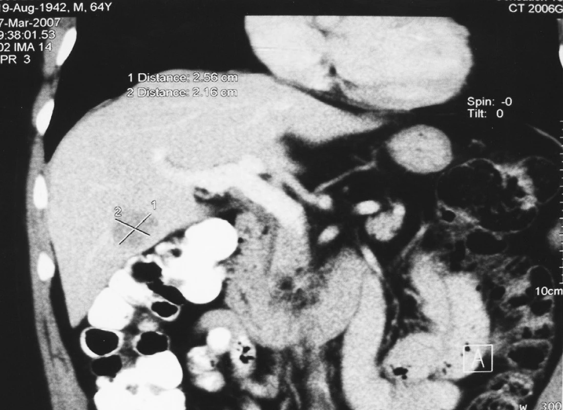 Předoperační CT metastázy kolorektálního karcinomu o průměru 2 cm v V. jaterním segmentu
Fig. 1. Preoperative CT – colorectal carcinoma metastases of 2 cm in a diameter, in segment V of the liver