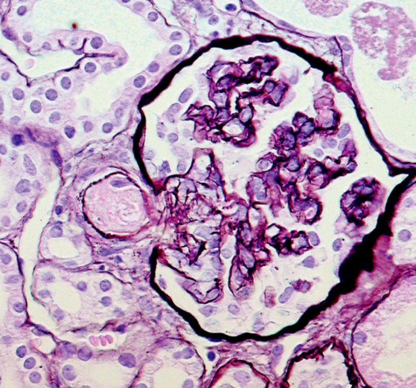 Ischemicky kolabovaný glomerulus s trombotickým uzávěrem v přívodné arteriole (vas afferens)
(barvení PASM [periodic acid – silver methenamine]; objektiv 40krát) 
