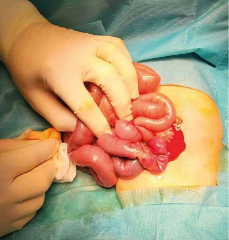 Perioperačný nález, kľučky tenkého čreva po manuálnom pretlačení obsahu per vias naturales