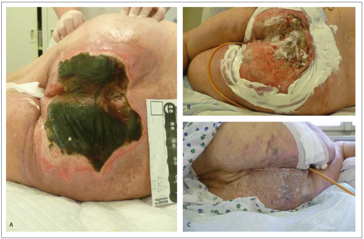 Patient, 64-years-old female, casus socialis. Moves around on the wheelchair, condition after amputation of right lower limb above
knee (A–C).<br>
Obr. 5. Pacientka, 64 letá žena, casus socialis. Pohybuje se na invalidním vozíku, stav po amputaci pravé dolní končetiny ve stehně, defekt
na hýždi (A–C).