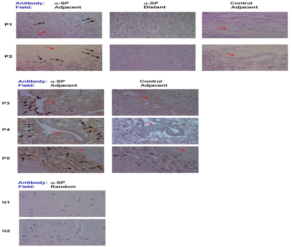 SP immunostaining of brain tissue samples from NCC-infected and uninfected patients.