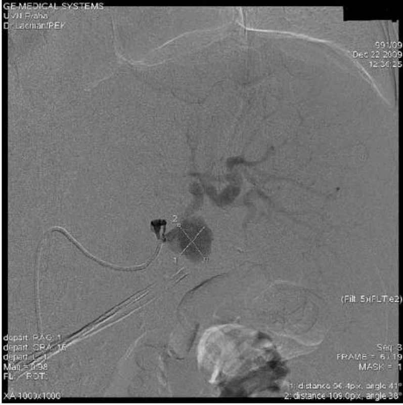DSA po kanylaci a. lienalis a nástřiku pseudoaneurysmatu.
Fig. 2. DSA of the splenic artery and injection of the pseudoaneurysm.