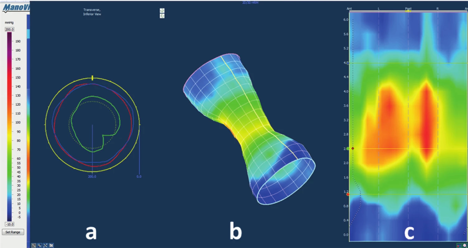 Anorectal resting pressure morphology