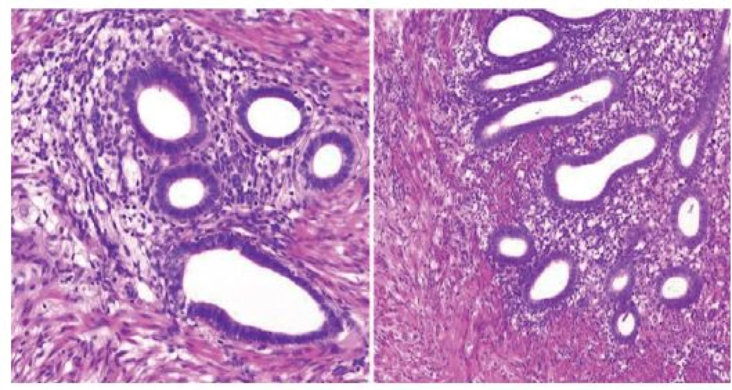Histopatologický obraz endometriózy ( barvení hemotoxilin&amp;eosin)
Fig. 3: Histopathological finding (hematoxilin and eosin)