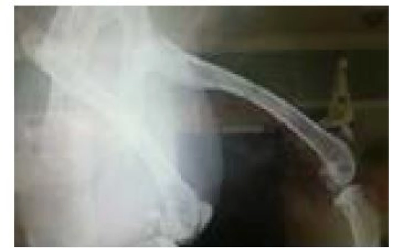 RTG image of the subject after 2 weeks.