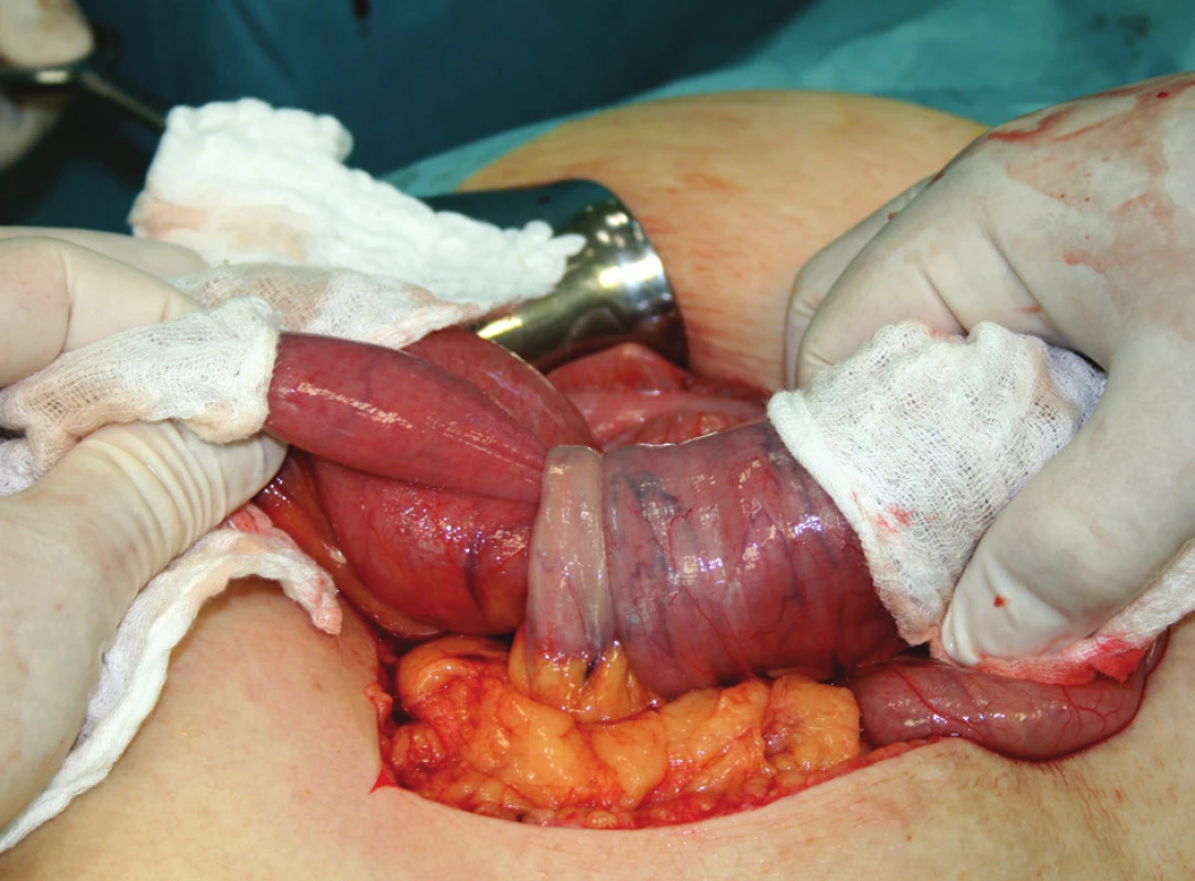 Intususcepce jejuna kolem metastázy maligního melanomu
Fig. 2. Jejunal intususception around the malignant melanoma metastasis