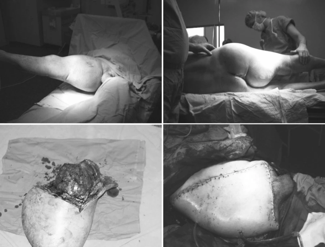 a-d. Rozšířená hemipelvectomie, peroperační foto
Pic. 1a-d. External hemipelvectomy, peroperative picture