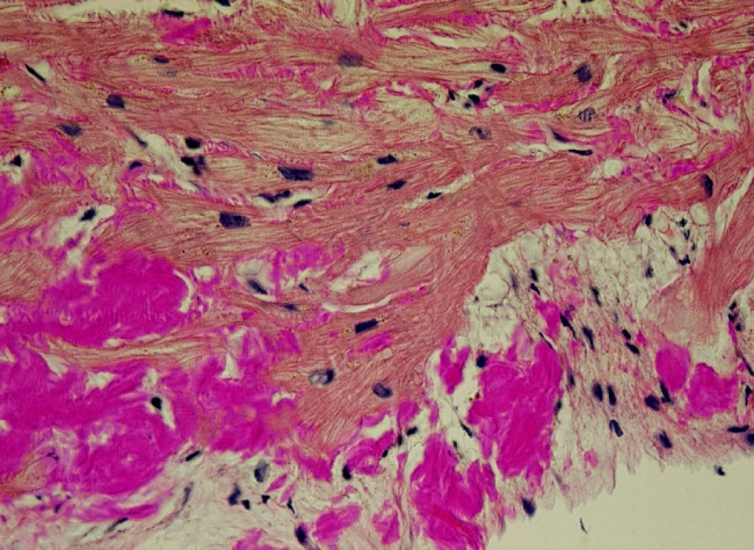 Depozita amyloidu v endomyokardiální biopsii (barvení Saturnovou červení, objektiv 40krát)

