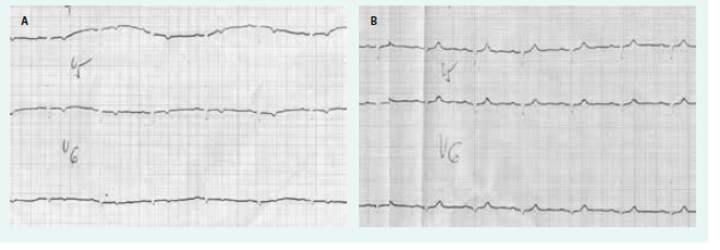 EKG u hypotyreózy.