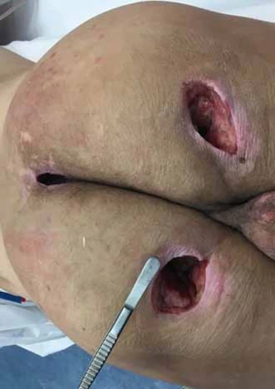 Stav po nekrektomii sakrálního a obou ischiadických dekubitů.
Fig. 5. Condition after necrectomy of sacrall and both sciatic decubitus (pressure ulcers).