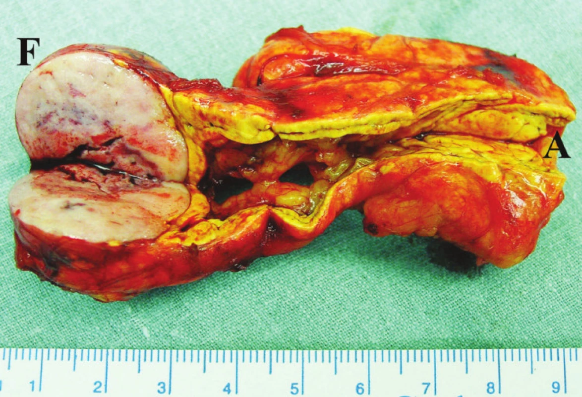 Feochromocytom (F) a adenom (A) v levé nadledvině
Fig. 2. Feochromocytoma (F) and adenoma (A) in the left adrenal gland