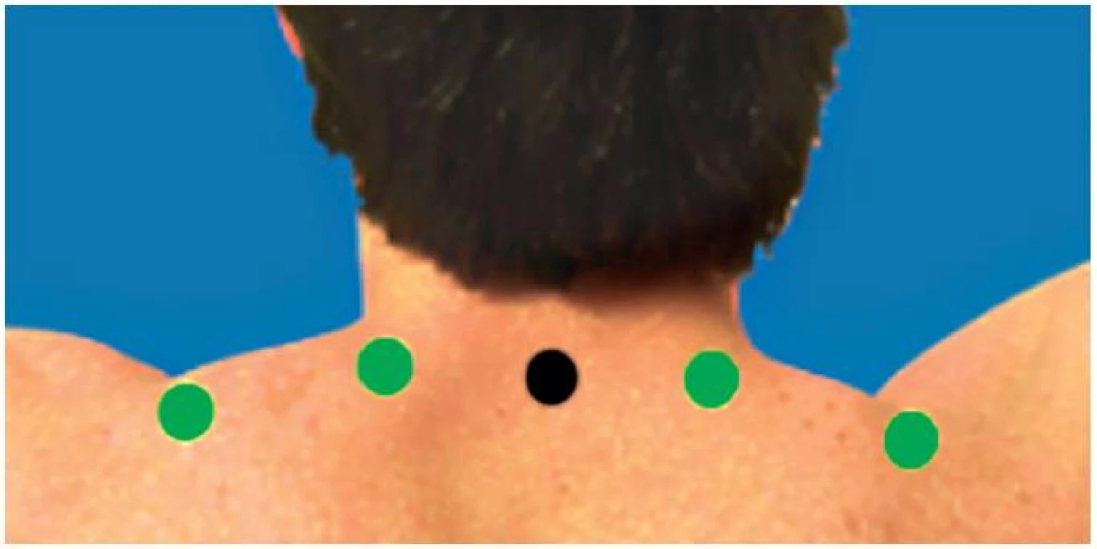 Umiestnenie elektród v oblasti m. trapezius.
<i>(Obrázok je kopírovaný z databázy prístroja Biofeedback 2000
x-pert od firmy Schuhfried.)</i>