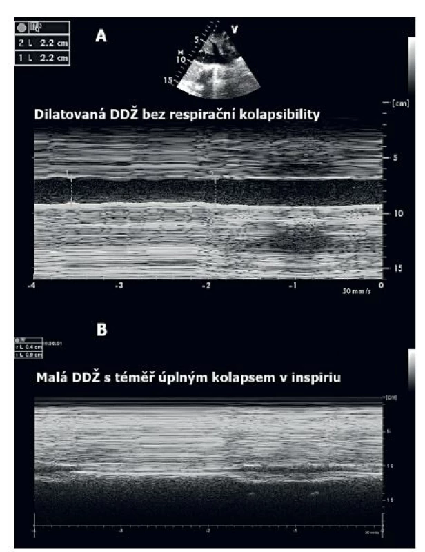 Měření rozměrů dolní duté žíly v subkostální projekci během umělé plicní ventilace