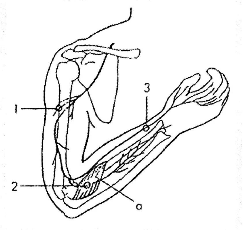 N. radialis.
Úžiny:
1 – r. cutaneus brachii posterior (průchod fascií paže),
2 – supinátorový tunel (a v hloubi n. interosseus posterior),
3 – r. superficialis na distálním předloktí.
Sval: a – m. supinator.
