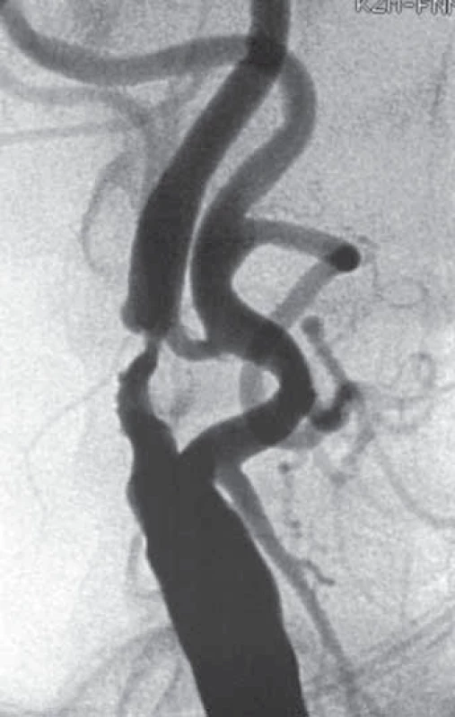 Angiogram stenotické karotické tepny.
 