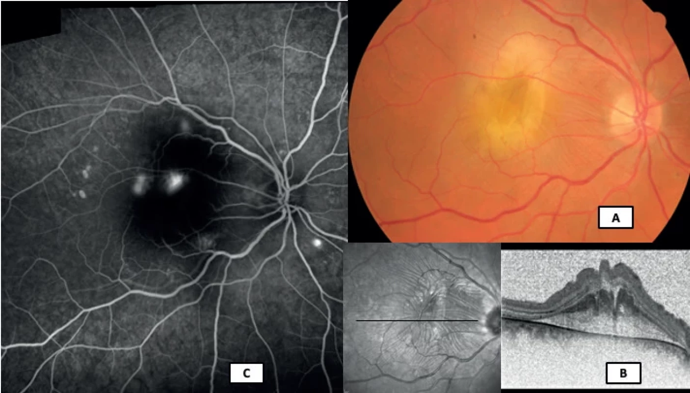 Color fundus photo, optical coherence tomography scan and fluorescein angiography (Visucam Zeiss, Heidelberg Spectralis, Myslík Manethová)