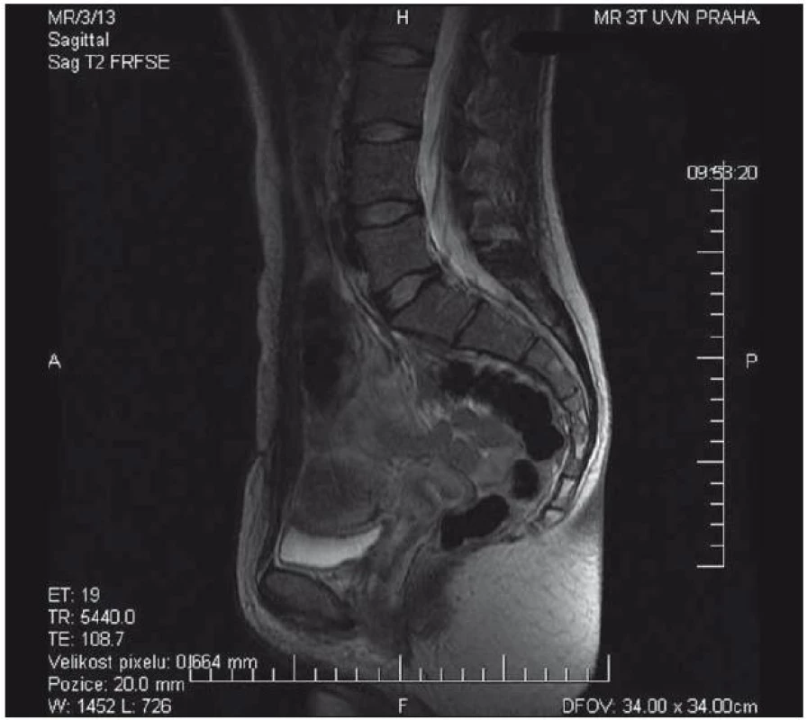 MR kontrola v T2 váženém obraze – stav po resekci po neurofibromu bez známek recidivy či rezidua procesu.