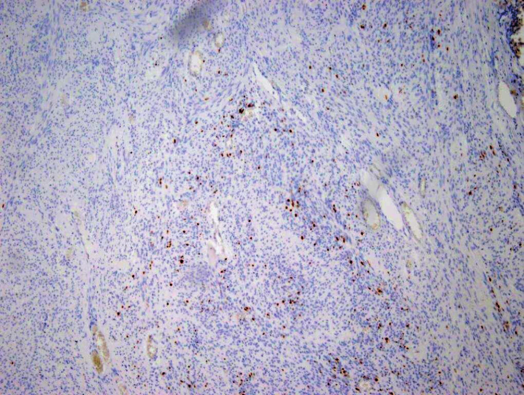 Imunohistochemické vyšetření Ki-67, které ukazuje na proliferační aktivitu − v tomto případě nízkou
Fig. 2: Ki-67 immunohistochemistry indicating proliferative activity − low in this case