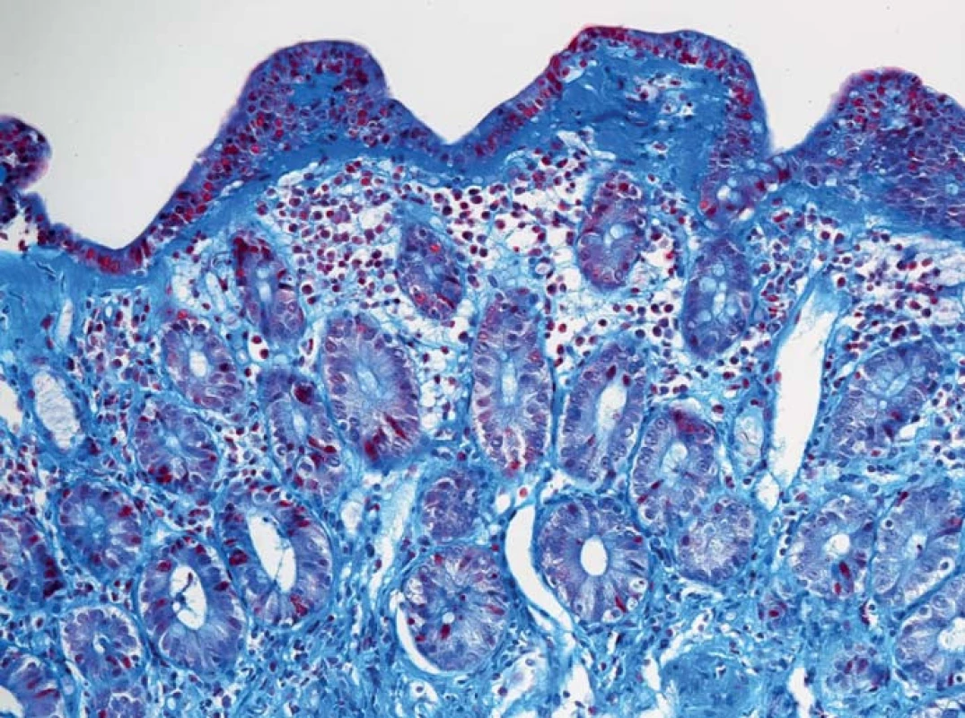 Histologický obraz sliznice terminálního ilea se sytě modrým pásem subepiteliálního hyalinního materiálu při kolagenní ileitidě (modrý trichrom, zvětšení 200×).
Fig. 4. Histology of terminal ileal mucosa with a deep blue band of subepithelial hyalin material: collagen ileitis (blue trichrome, magnification 200×).