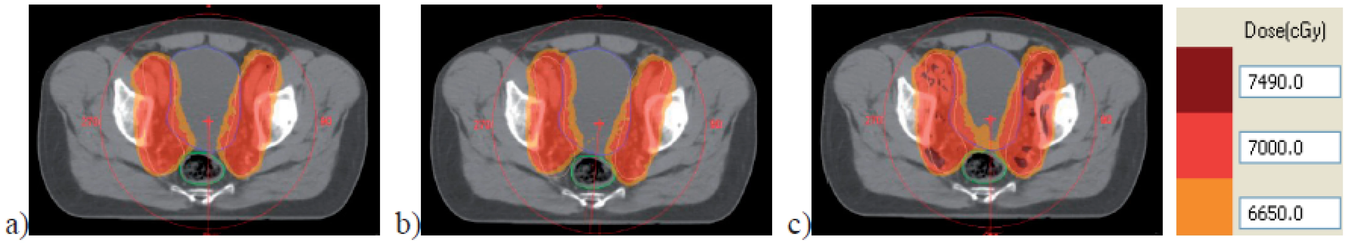 Dose distribution comparison of the original plan (a) to the plan with 5° gantry angle change (b) and to 2 mm field size change (c) for the prostate case (18MV energy).