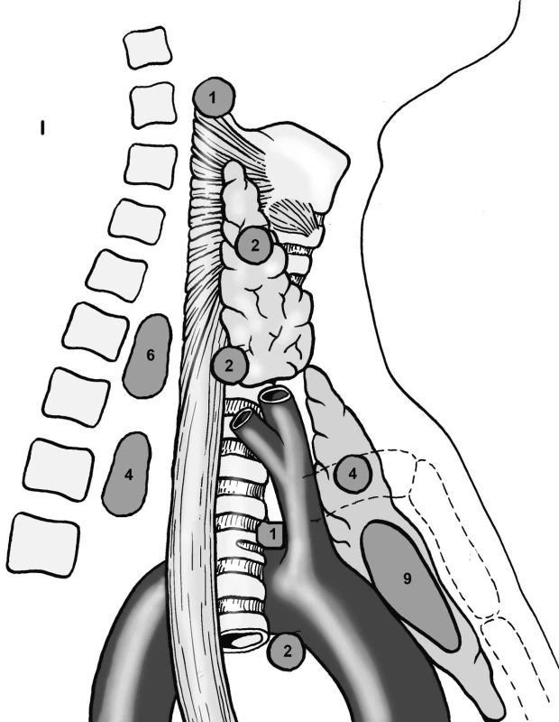 Přehled lokalizací patologické tkáně paratyreoidey při reoperacích.
Pic. 2. Overview of locations of the parathyroid pathological tissue during reoperations