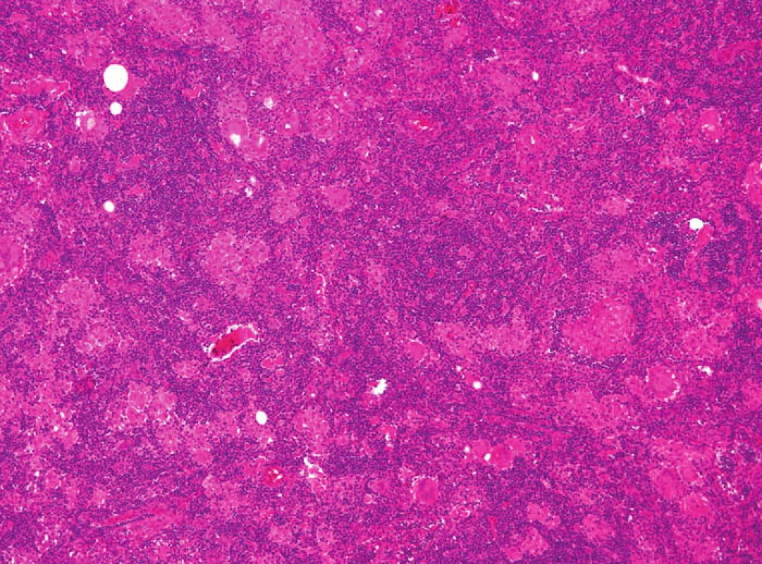 Granulomatózní struktury s četnými obrovskými mnohojadernými buňkami.
Fig. 4: Granulomatous structures with multiple multinucleated cells