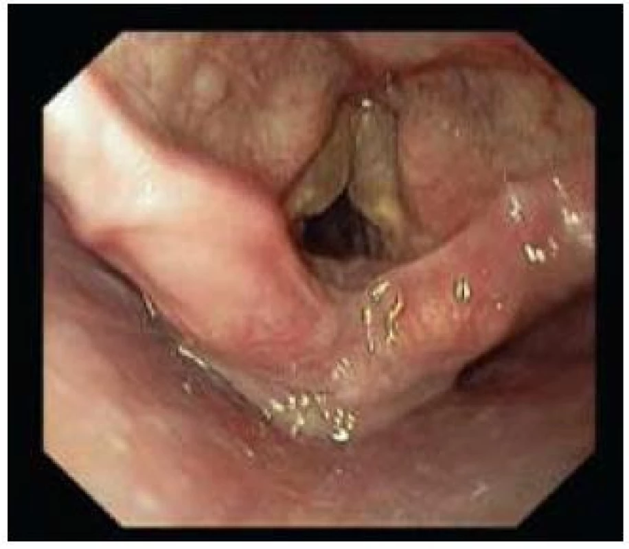 Reinkeho edém oboustranně.
Fig. 10. Reinke’s oedema of both vocal cords.