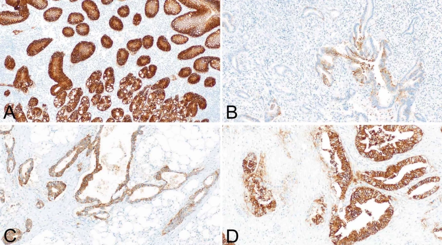 Imunohistochemická exprese claudinu 18.2 (certifikovaný kit Ventana). Silně intenzivní pozitivita v epitelu nenádorové sliznice žaludku (100x) (A). Fokální pozitivita v adenokarcinomu žaludku - s ohledem na interpretační kritéria je nález negativní (100x) (B). Středně a silně intenzivní pozitivita v metastáze adenokarcinomu žaludku (hodnoceno jako pozitivní) (100x) (C). Difúzní silně intenzivní pozitivita žaludečního adenokarcinomu (100x) (D).
